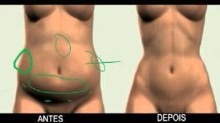 Lipoaspiração Abdominal (na Barriga) Feminina X Lipoescultura - Cirurgia  Plástica 