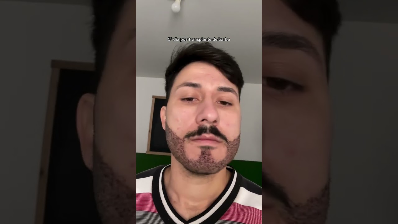 Transplante de barba: antes e depois. 