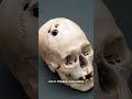 Trepanning: The Original Lobotomy