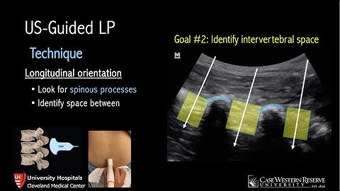 Ultrasound-Guided Lumbar Puncture