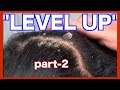 Small Kine part-2 | Dry Flaky Scalp