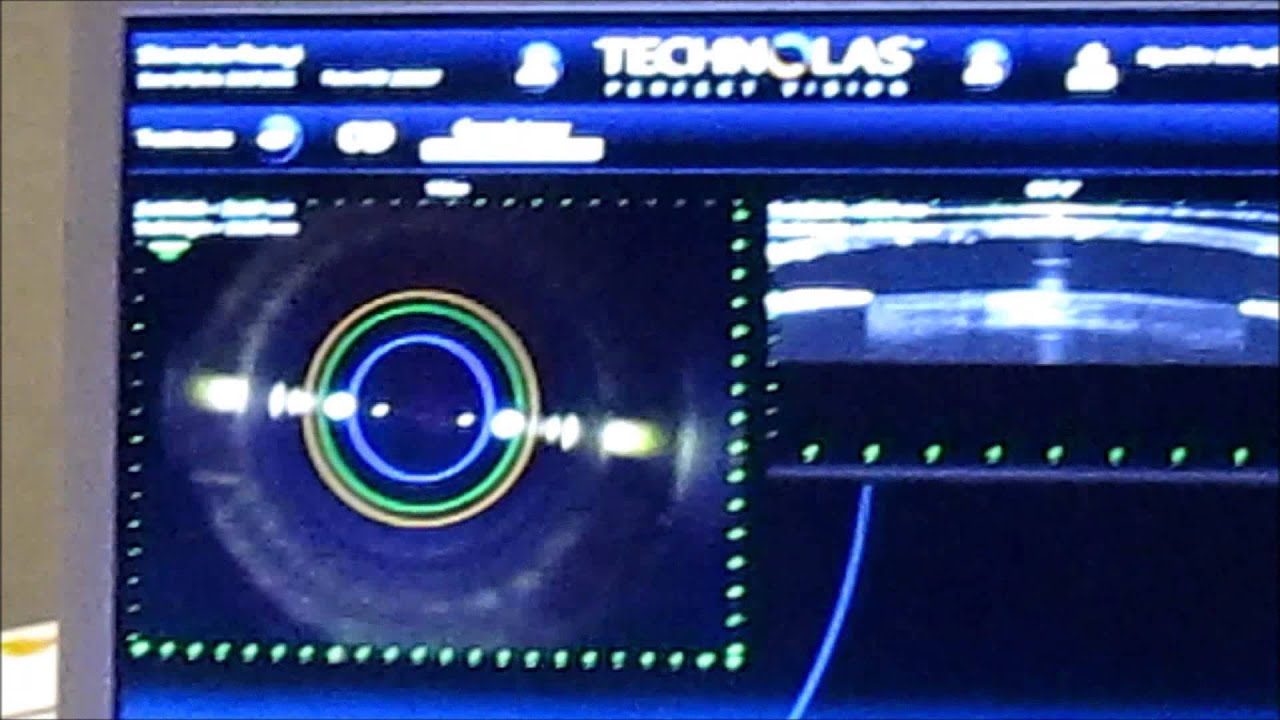 Victus Femtosecond Laser capsulotomy procedure - Jeffrey Whitman, MD