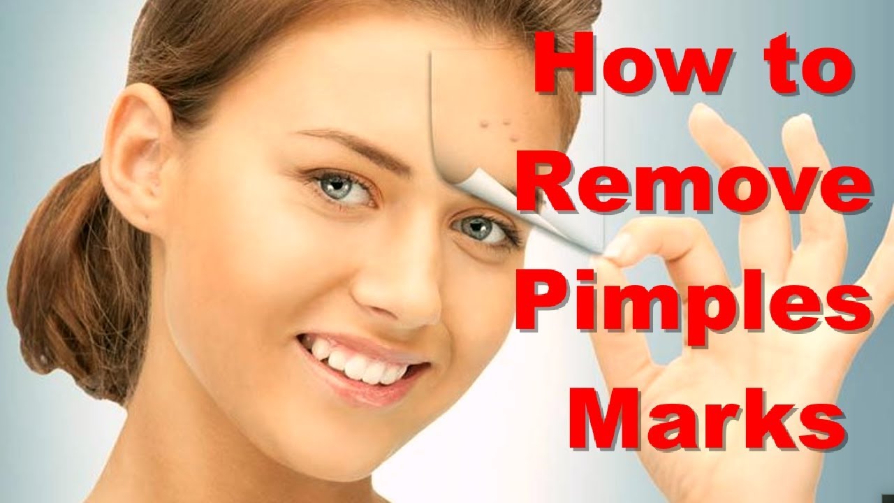 How To Remove Pimples Marks How To Remove Pimples Marks In One Day With