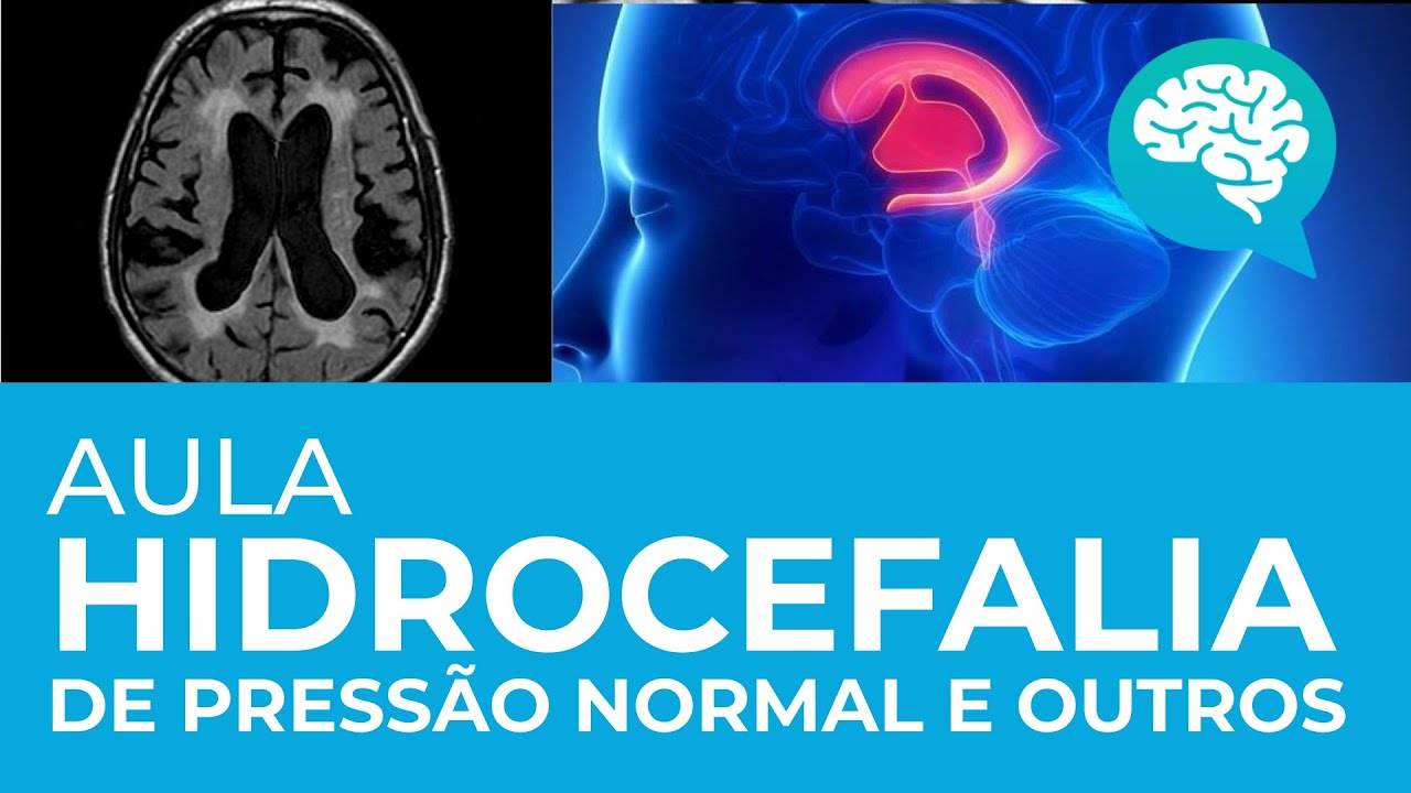 HIDROCEFALIA DE PRESSÃO NORMAL E OUTROS Correlação clínico radiológica AULA YouTube HIDROCEFALIA DE PRESSÃO NORMAL E OUTROS Correlação clínico radiológica AULA YouTube