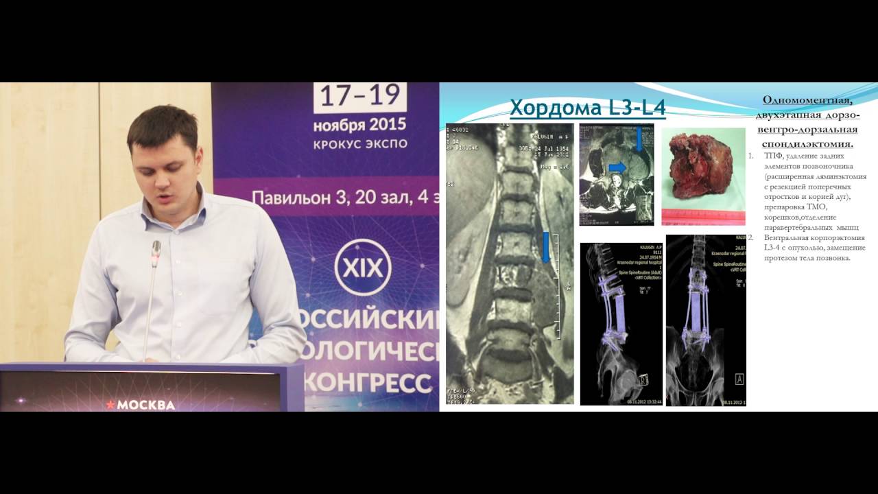 Опыт хирургического лечения больных с опухолями костей и мягких тканей НИИ – ККБ №1