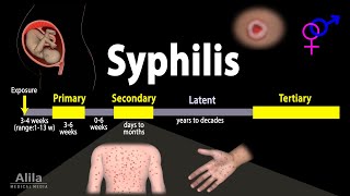 Syphilis  Pathophysiology, Diagnosis and Treatments, Animation