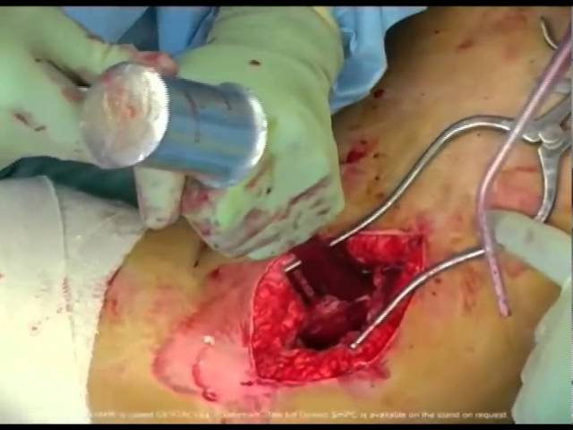 Остеомиелит бедра