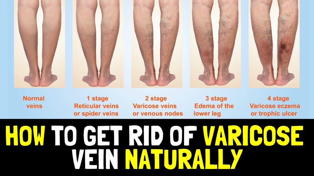 How to Get Rid of Varicose Veins Naturally at Home ? YouTube