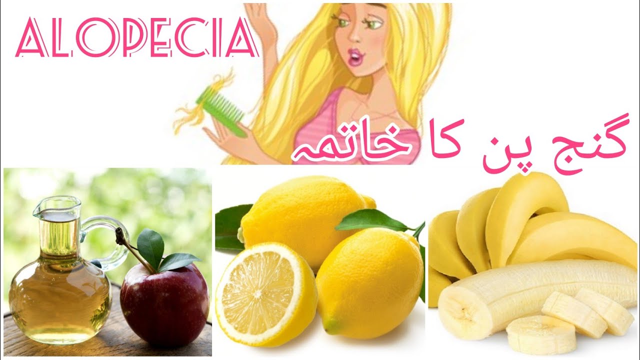 Home Treatment/ Remedy for Alopecia گنج پن کا آسان ترین گھریلو علاج