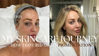 MY SKINCARE JOURNEY | HOW I GOT RID OF MY PIGMENTATION