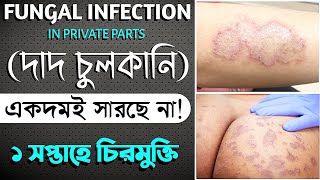 Fungal Infection in Private Parts Treatment | গোপন অংশের দাদ চুলকানির ১০০% সমাধান | screenshot 5