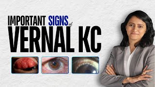 Important signs of Vernal KC - Nikmonic #neetpg