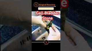 Gallbladder stone due to Alcohol #doctorexplains #shortsfeed #medicalreels #mbbs #mbbsmotivation