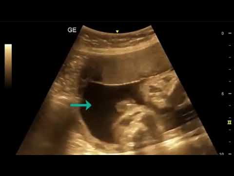 ULTRASONDA ERKEK BEBEK GÖRÜNTÜSÜ YouTube