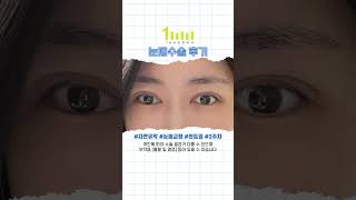 자연유착 눈매교정 윗트임 후기