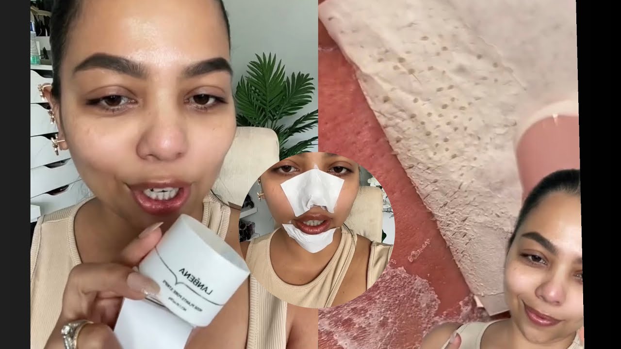 Best blackhead and whitehead removal! ⁠ YouTube