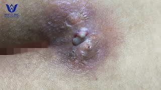 Nặn Mụn Áp Xe Vùng Xương Cụt - Tại Phòng Khám Da Liễu Hhv Clinic
