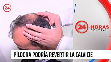 ¿Se puede revertir la calvicie?