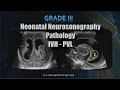 Neonatal Neurosonography | Pathology | IVH - PVL