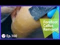 TOP MEDICAL PEDICURE Ep.100 - Relaxing Forefoot Callus Removal And Screaming