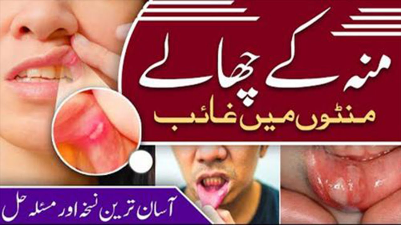 mun k chalon ka ilaj mouth ulcer Treatment at home how to get rid of mouth blisters Tongue