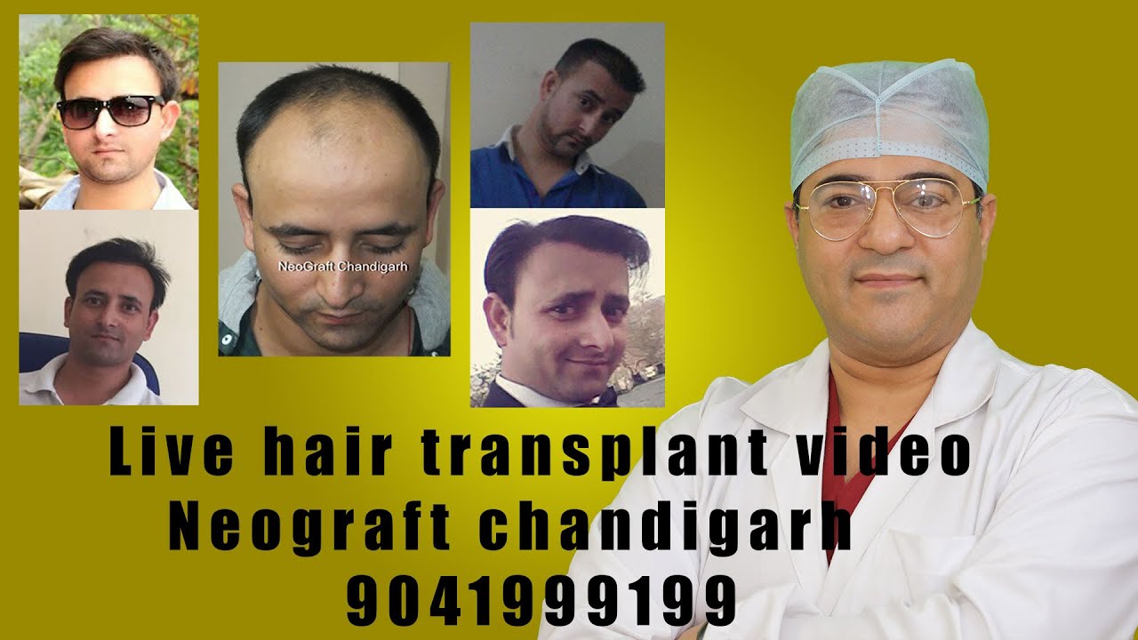 HAIR LOSS SOLUTION WITH SCALP MICRO PIGMENTATION CHANDIGARH, , PUNJAB  INDIA. - YouTube