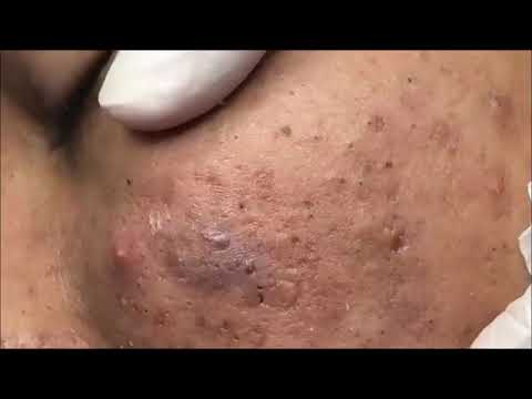 HUGE CYSTIC ACNE EXTRACTION #