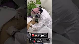 نتيجه حقن ميزوثيرابي لإذابة دهون البطن 🤟🏻💉