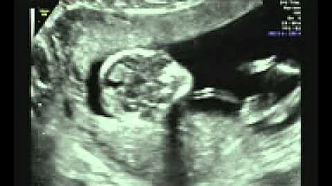 Angela and Patrick Hussey - Baby Ultrasound