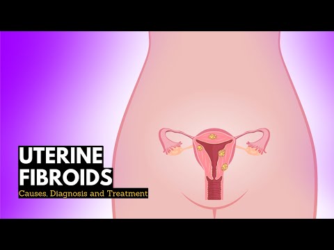 Video: Intramural Fibroid: Symptomer, Diagnose Og Behandling