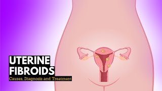 Uterine Fibroids, Causes, Signs and Symptoms, Diagnosis and Treatment.