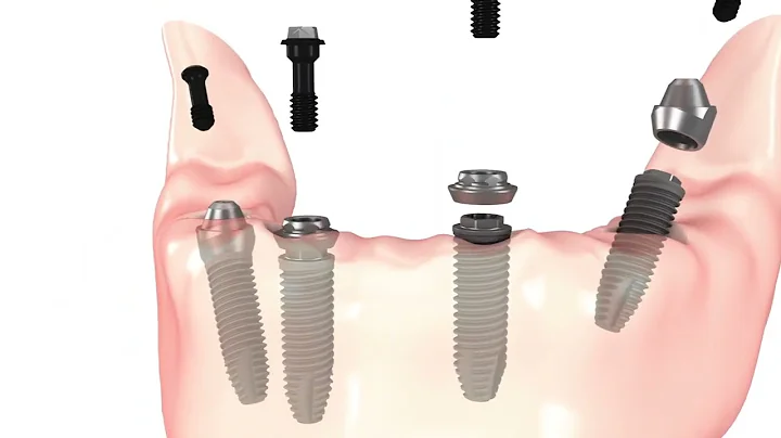 All on 4 Dental Implants Simple Procedure Animation