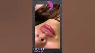 فيلر الشفاة الاجمل دائما فقط في أميمة الطبي Clinic تجميل أطباء عيادات أميمة 