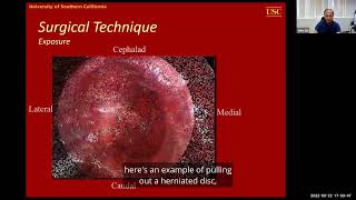 Minimally Invasive Techniques in Spine Trauma