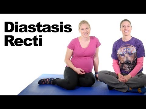 Videó: Diastasis Recti: Tünetek, Kezelés, Megelőzés és így Tovább