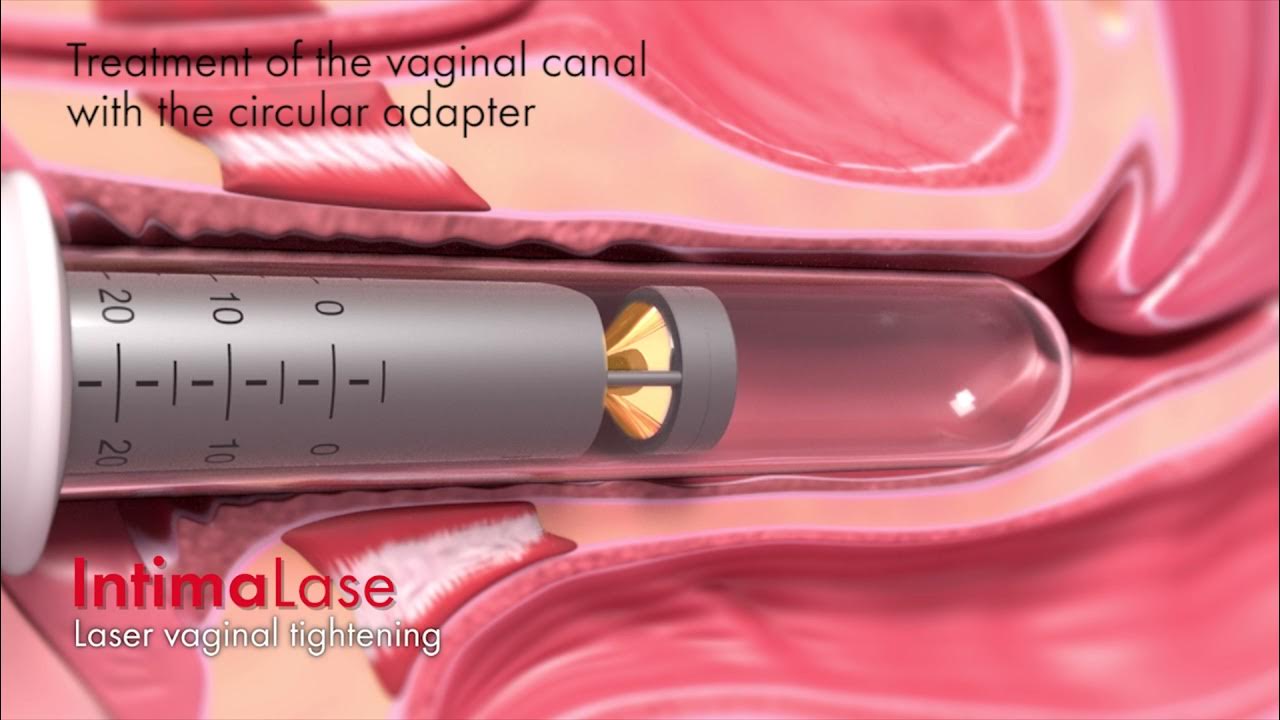 traitement IntimaLase (relâchement vaginal) YouTube
