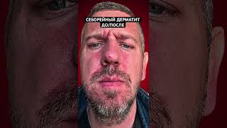 ТЫ ЕЩЕ МАЖЕШЬСЯ ТРИДЕРМОМ? Лечение себорейного дерматита без гормональных #себорея
