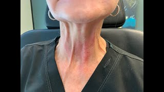 Injecting Botox in the Neck to relax neck bands