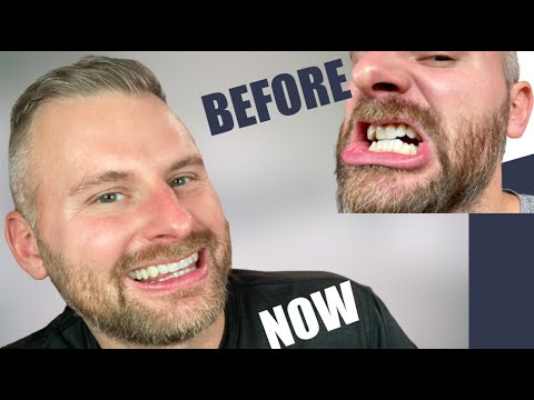 Видео: Candid Co. Teeth Straightening Aligner Results and Review