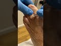 Prevent Toe Ulcers: Avoid Infection and Amputation