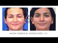 Facial Feminization Patient Testimonial | Align Surgical Associates