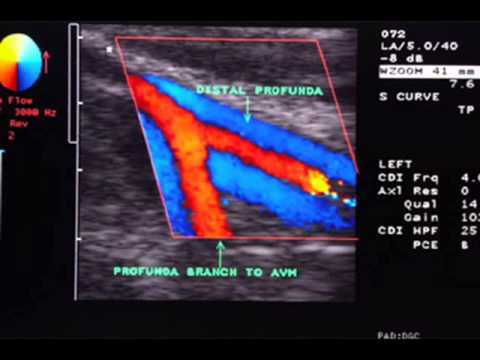 Resultado de imagen para ultrasonido doppler