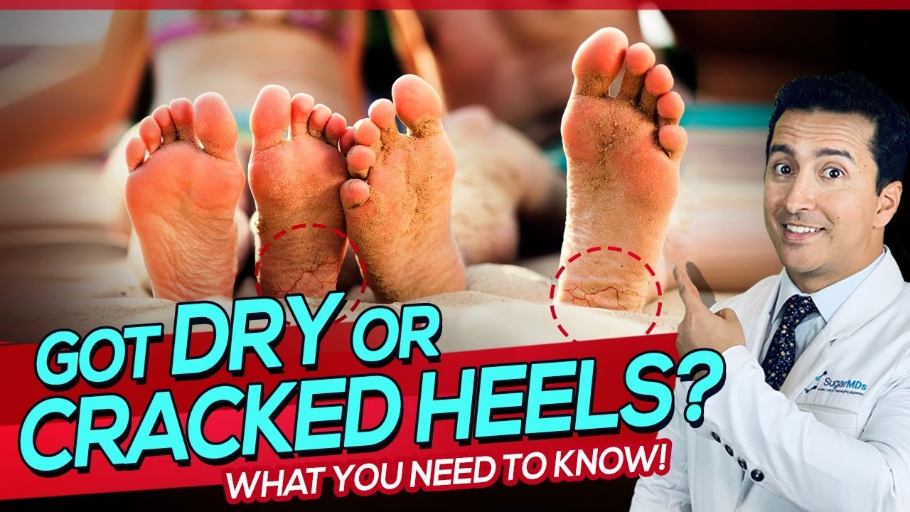 How to Heal Dry, Cracked Heels | GQ