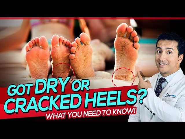Suffering from dry, cracked heels? Here's what to do