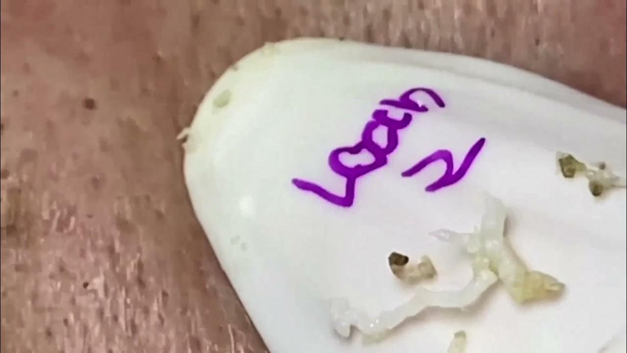 Extreme Blackhead Removal at LNG Skin Care enilsa brown 74292 YouTube