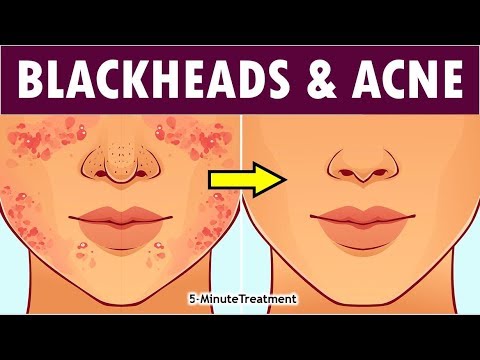 DIY How To Remove Blackheads and Whiteheads on Face | Acne Treatment | -Minute Treatment