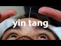 Yin tang affecting trigeminal nerve acupuncture  medicine  dongguk university los angeles
