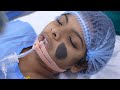 Huge Hairy Nevus Mole Staged Removal to Prevent Facial Disfigurement