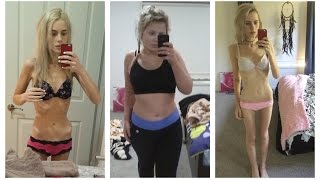 My Eating Disorder Story