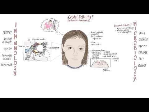 Orbital Cellulitis Springboard